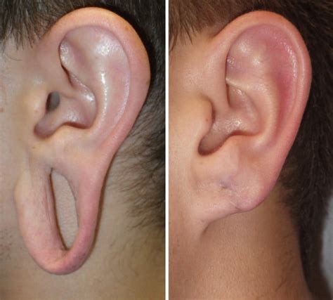 Can split earlobes heal?