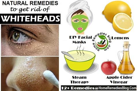 Can steam remove whiteheads?