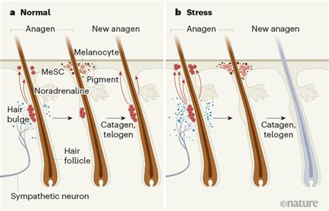 Can stress cause a streak of white hair?