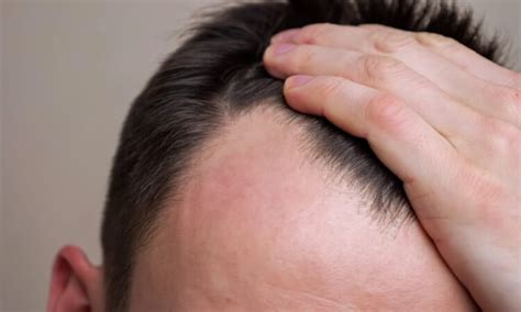 Can stress cause bald spots?