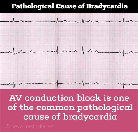 Can stress cause bradycardia?