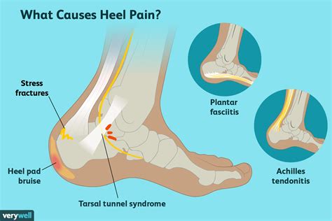 Can stress cause heel pain?