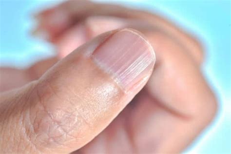 Can stress cause lines on fingernails?