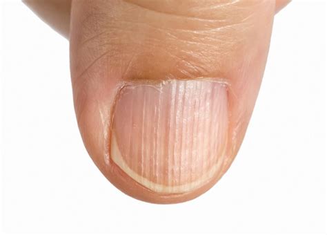 Can stress cause vertical lines on nails?