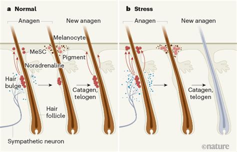 Can stress cause white hair?