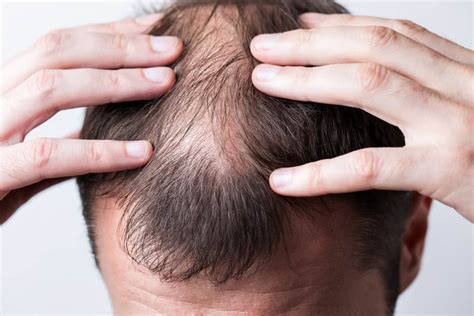 Can stress speed up balding?