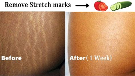 Can stretch marks fade in 2 months?