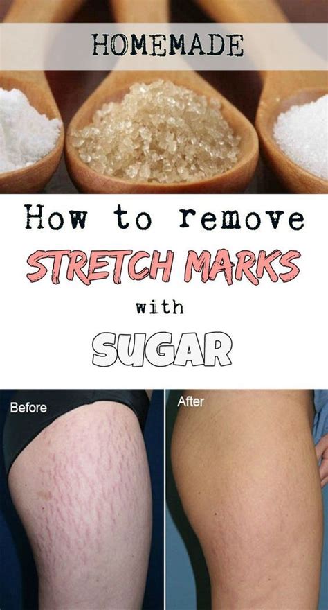 Can sugar remove stretch marks?