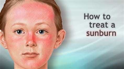 Can sunburn be permanent?