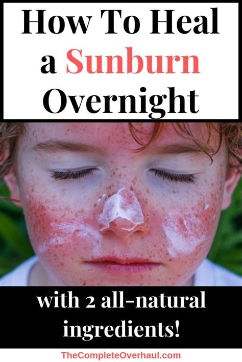 Can sunburn feel better overnight?