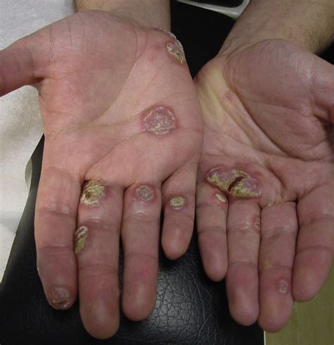 Can syphilis be on hands?
