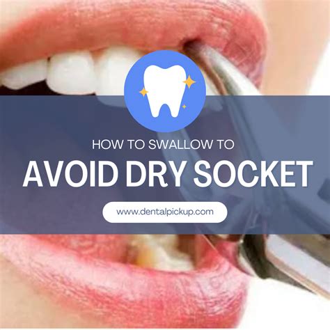 Can talking too much cause dry socket?