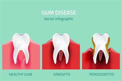 Can teeth be saved from gum disease?