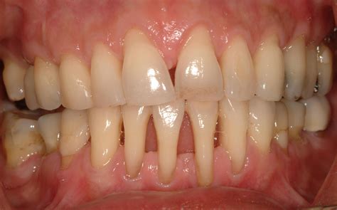 Can teeth be saved with advanced periodontal disease?