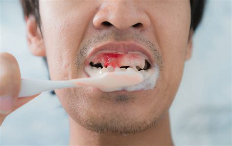 Can teeth bleed due to stress?