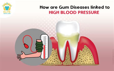 Can teeth cleaning lower blood pressure?