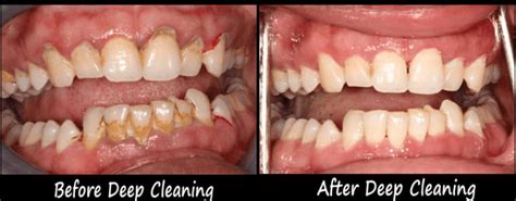 Can teeth fall out after deep cleaning?