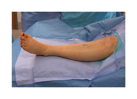 Can the peroneal nerve repair itself?