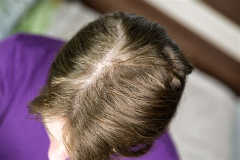 Can thin hair see scalp naturally?