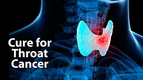 Can throat cancer be cured completely?