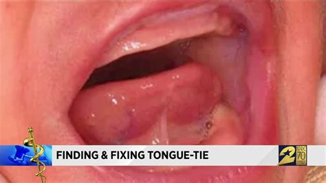 Can tongue tie change your voice?