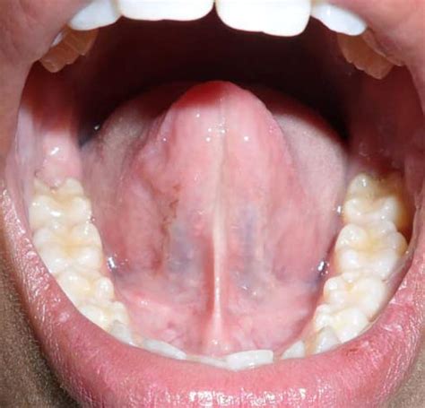 Can tongue-tie cause problems later in life?