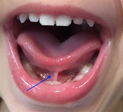 Can tongue-tie get worse with age?