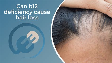 Can too much B12 cause hair loss?