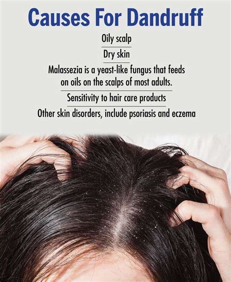 Can too much oil cause dandruff?