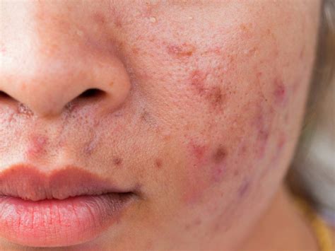 Can too much steam cause acne?
