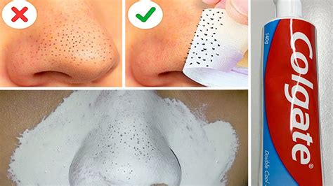 Can toothpaste remove blackheads?