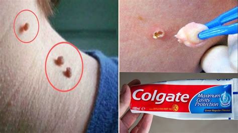 Can toothpaste remove skin tag?