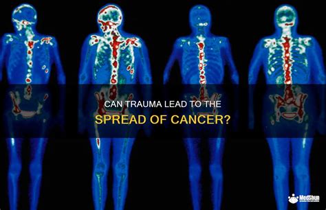 Can trauma cause cancer?