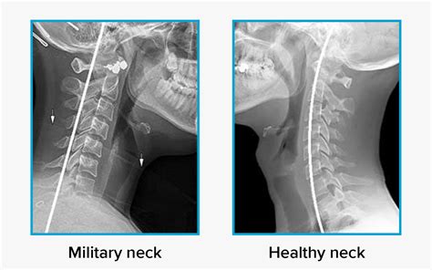 Can trauma cause military neck?