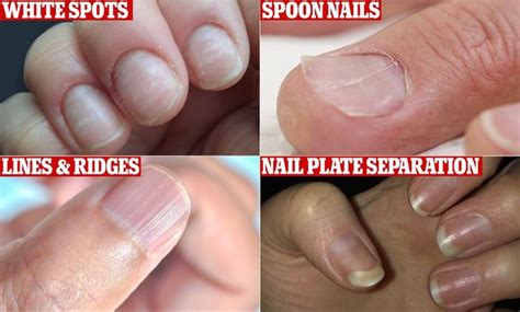 Can trauma show in your nails?