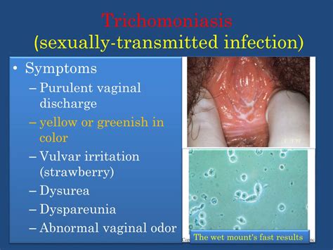 Can trichomoniasis spread to mouth?