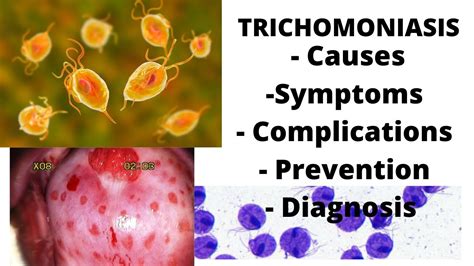 Can trichomoniasis survive outside body?