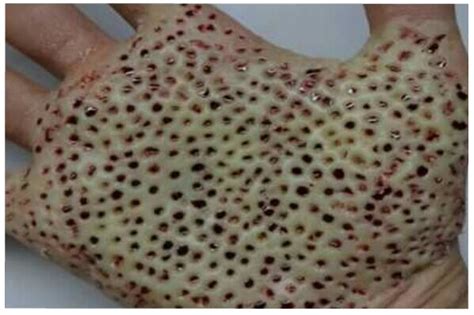 Can trypophobia be cured?