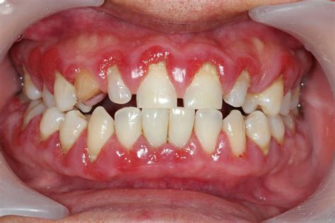 Can unhealthy gums recover?