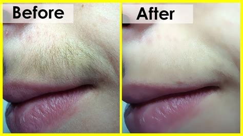Can upper lip hair be removed permanently?