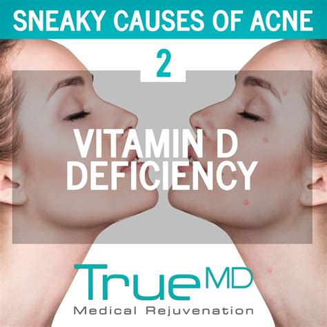 Can vitamin D cause acne?
