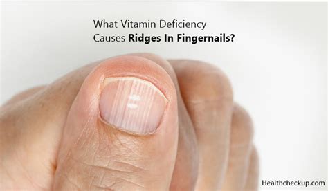 Can vitamin D deficiency cause nail ridges?