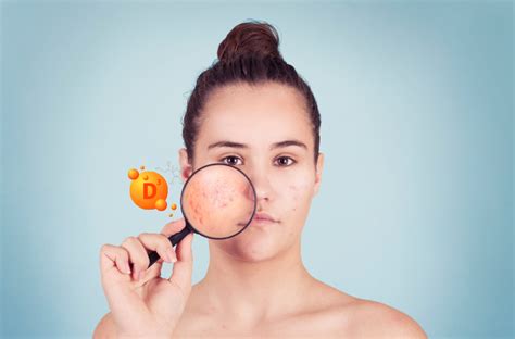 Can vitamin D supplements cause acne?