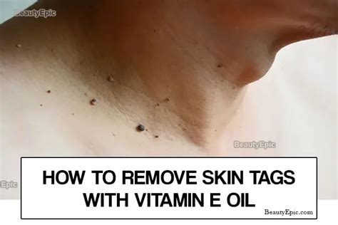 Can vitamin E oil remove skin tags?