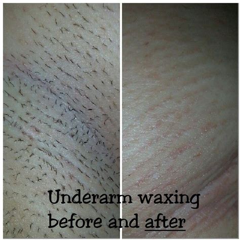 Can waxing get infected?