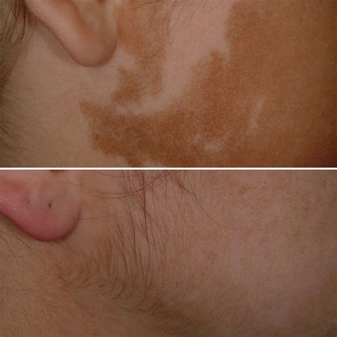 Can white birthmark be removed?