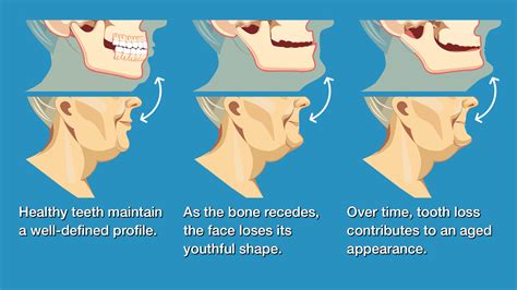 Can wisdom teeth cause face shape change?