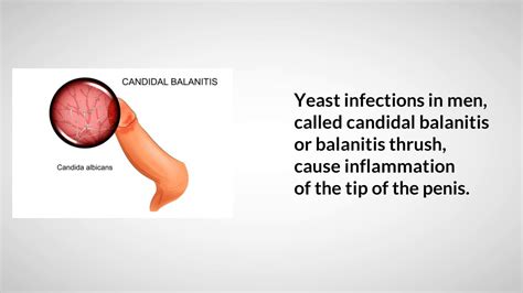 Can yeast infection be transferred to a man?