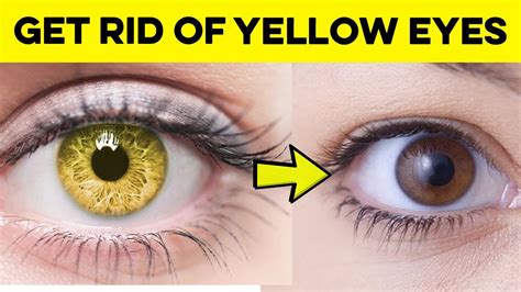 Can yellow eyes get better?