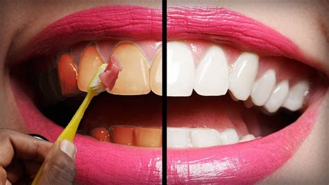 Can yellow teeth become white?